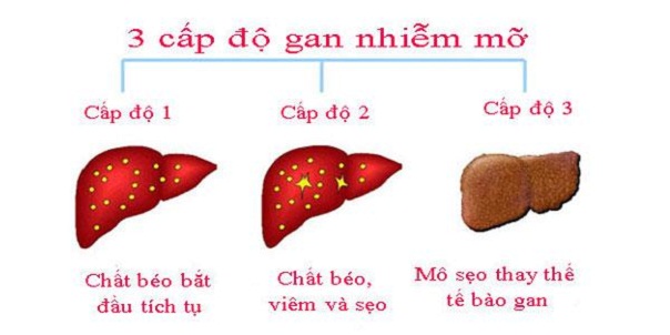 các cấp độ gan nhiễm mỡ